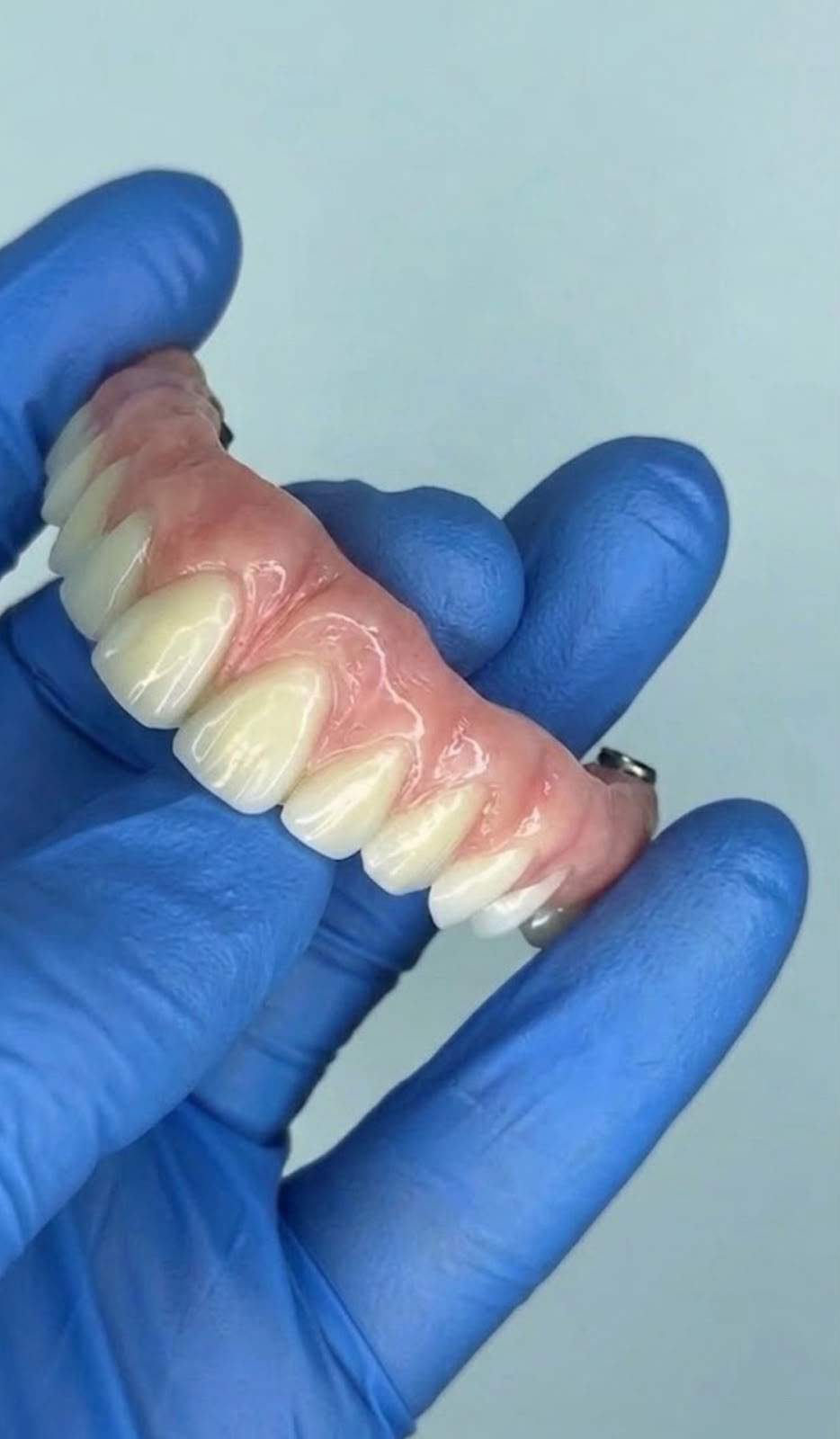 Prótese protocolo sobre implantes