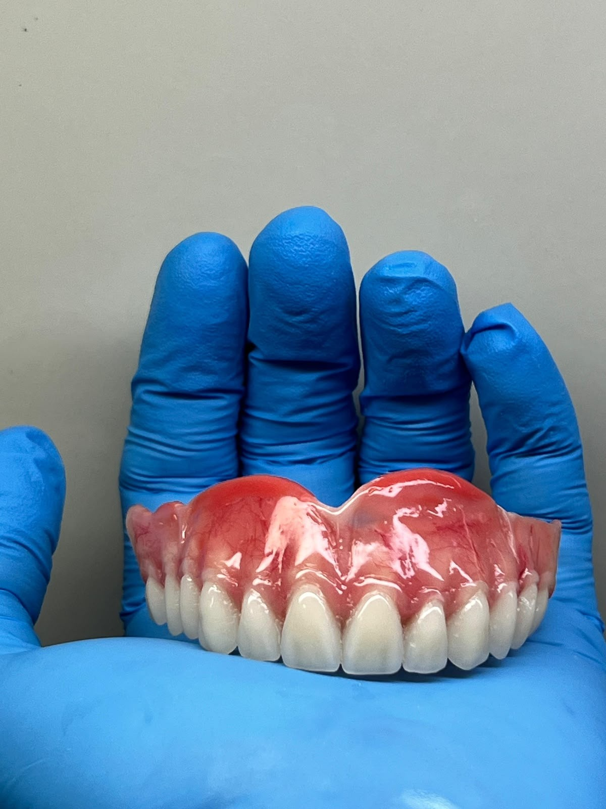 Prótese com gengiva caracterizada em mão com luva azul